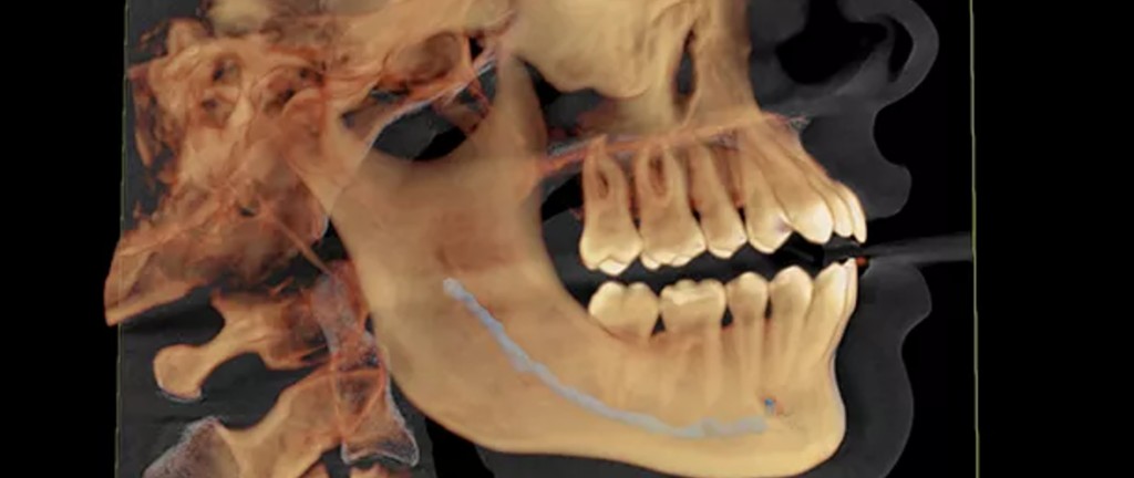 Dexis Op 3d EX Røntgenbillede Dexis Op 3d EX Røntgenbillede